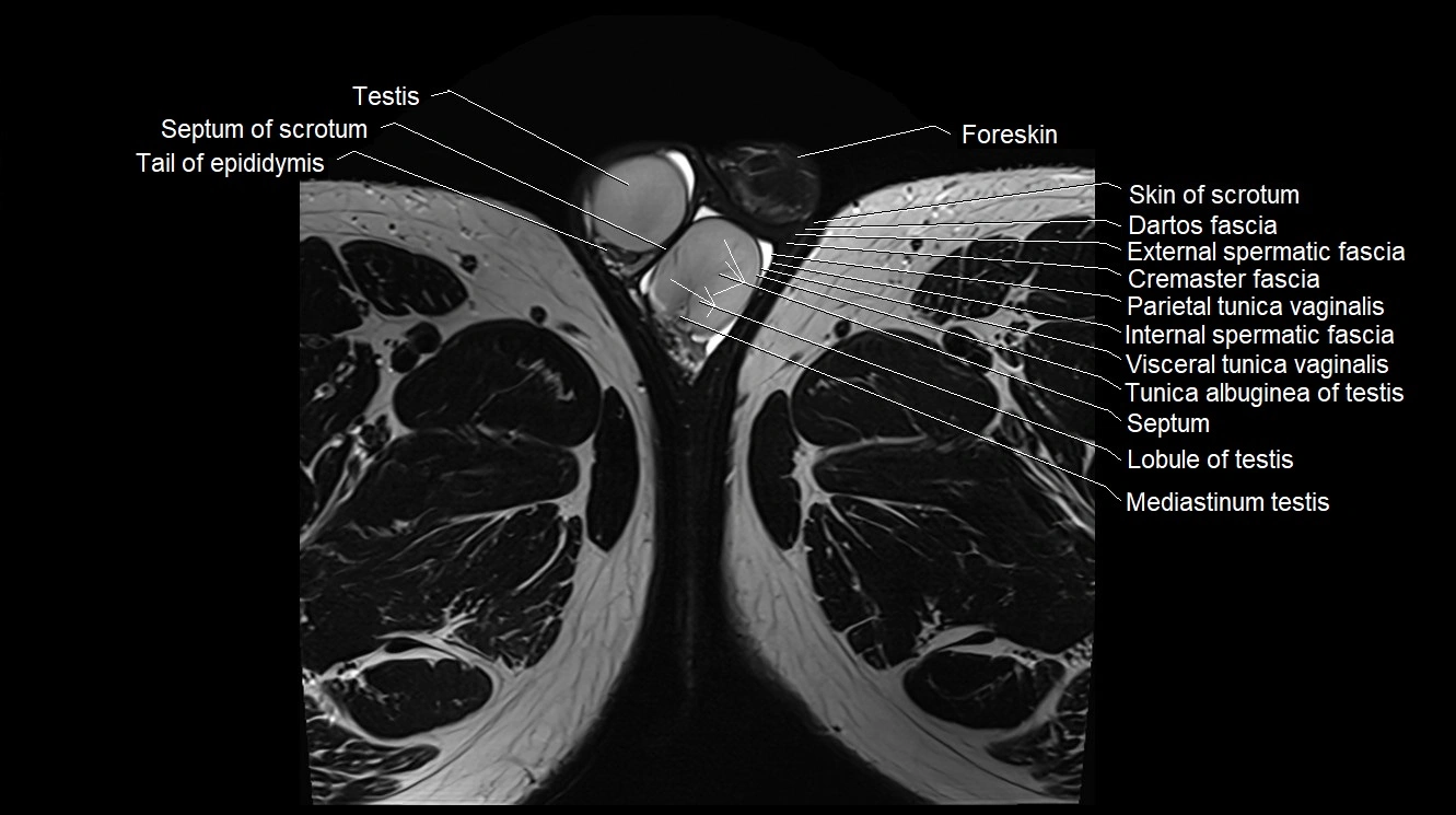 MRI 3T scrotum and penis axial cross sectional anatomy image 35.webp